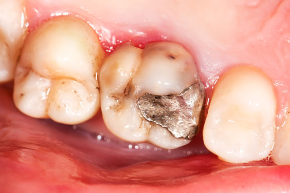 old amalgam restoration and molar caries