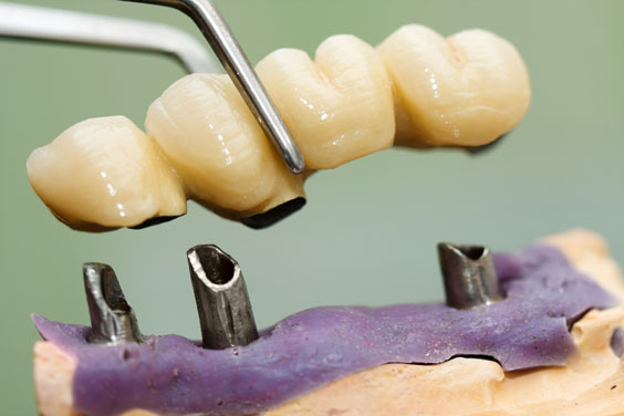 placing a dental implant head and bridge