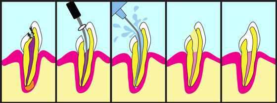 root canal steps